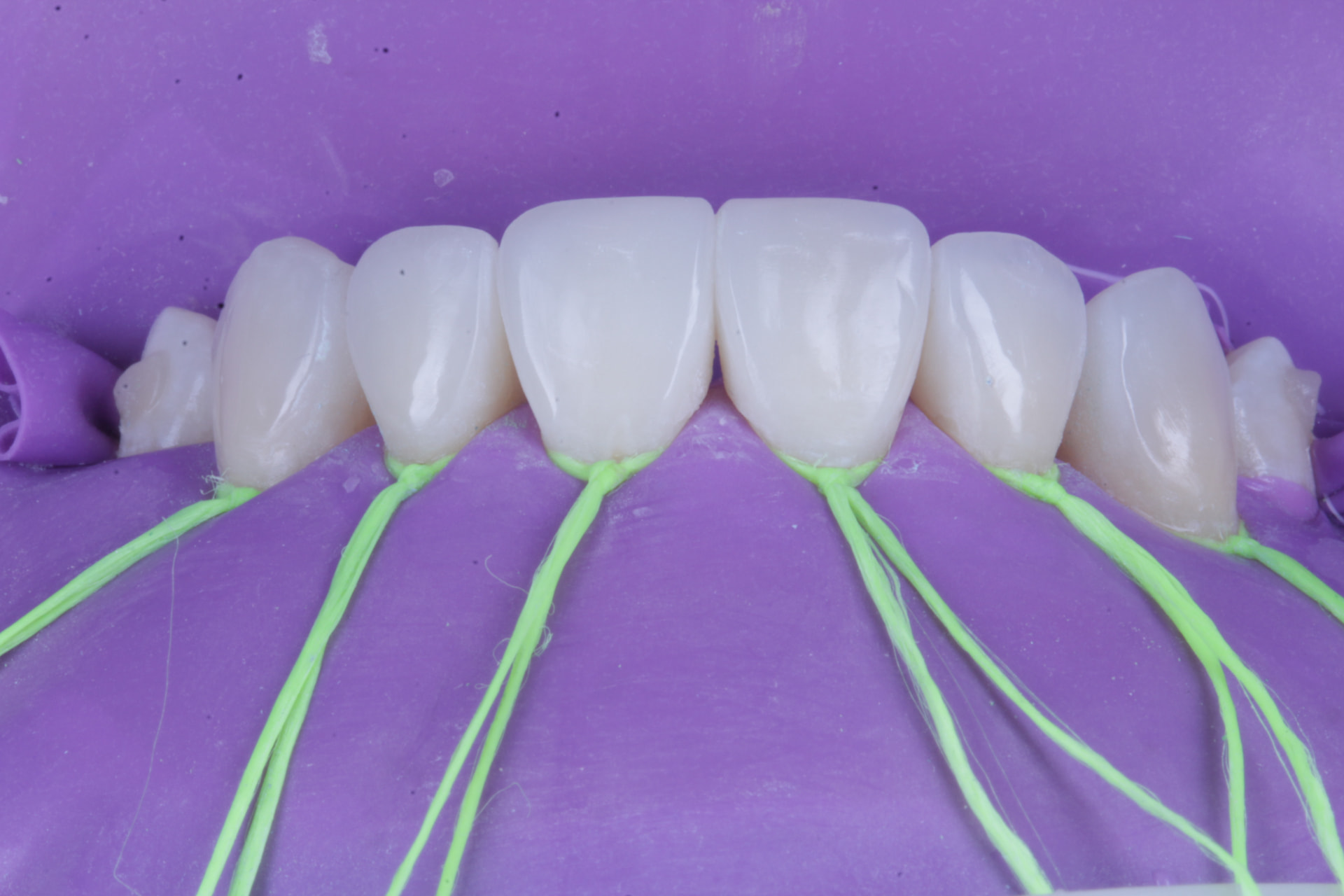 Fio retrator e acabamento cervical